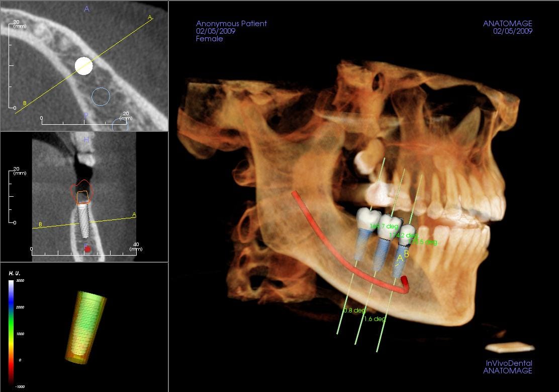 3D implant planning software