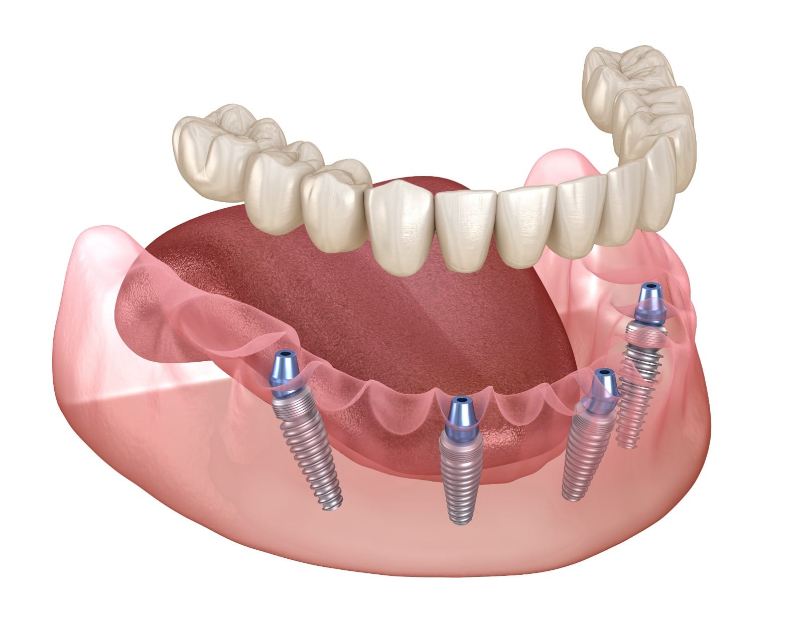 Mandibular prosthesis All on 4 system supported by implants. Medically accurate 3D illustration of human teeth and dentures concept
