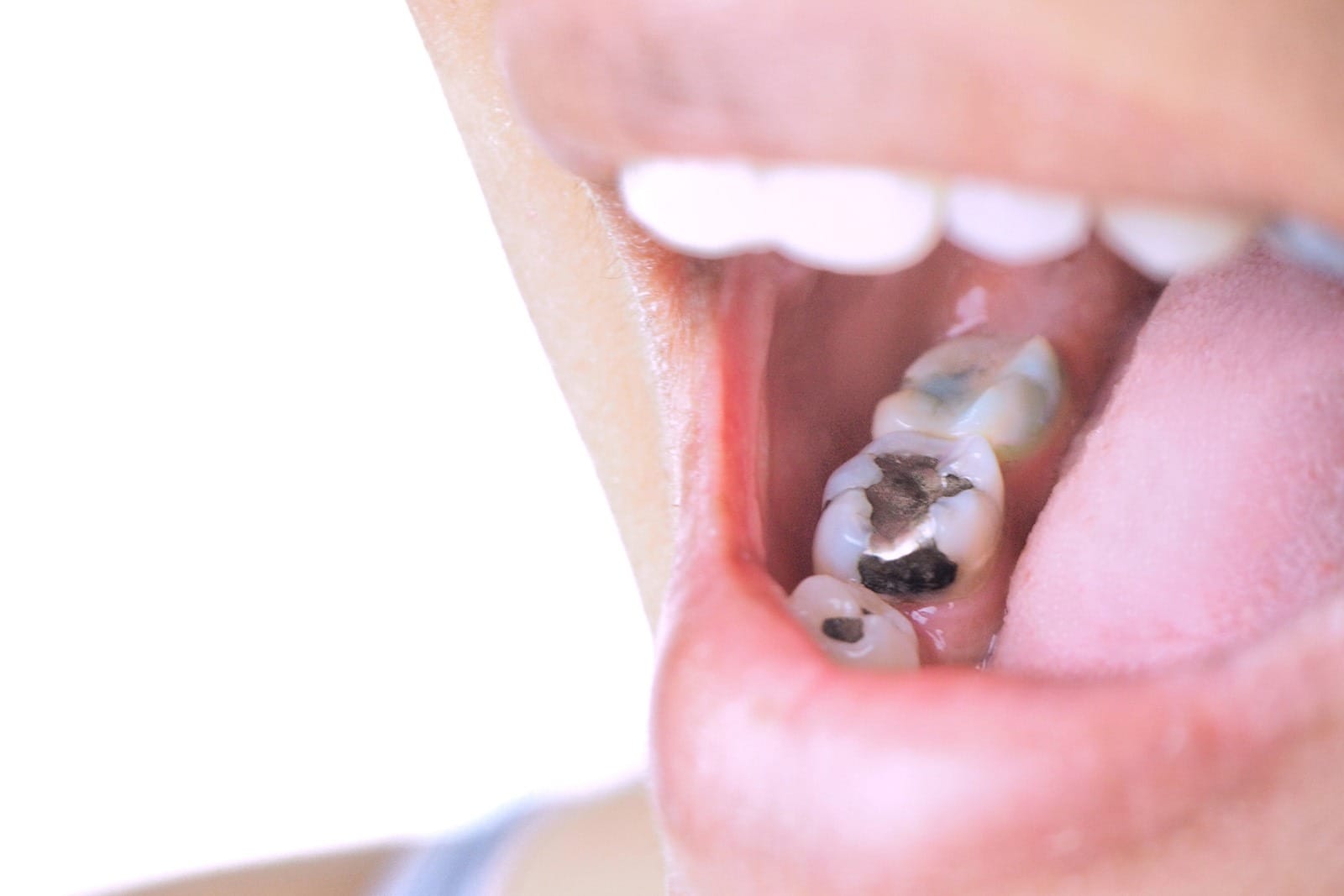 View of amalgam fillings on a person's mouth