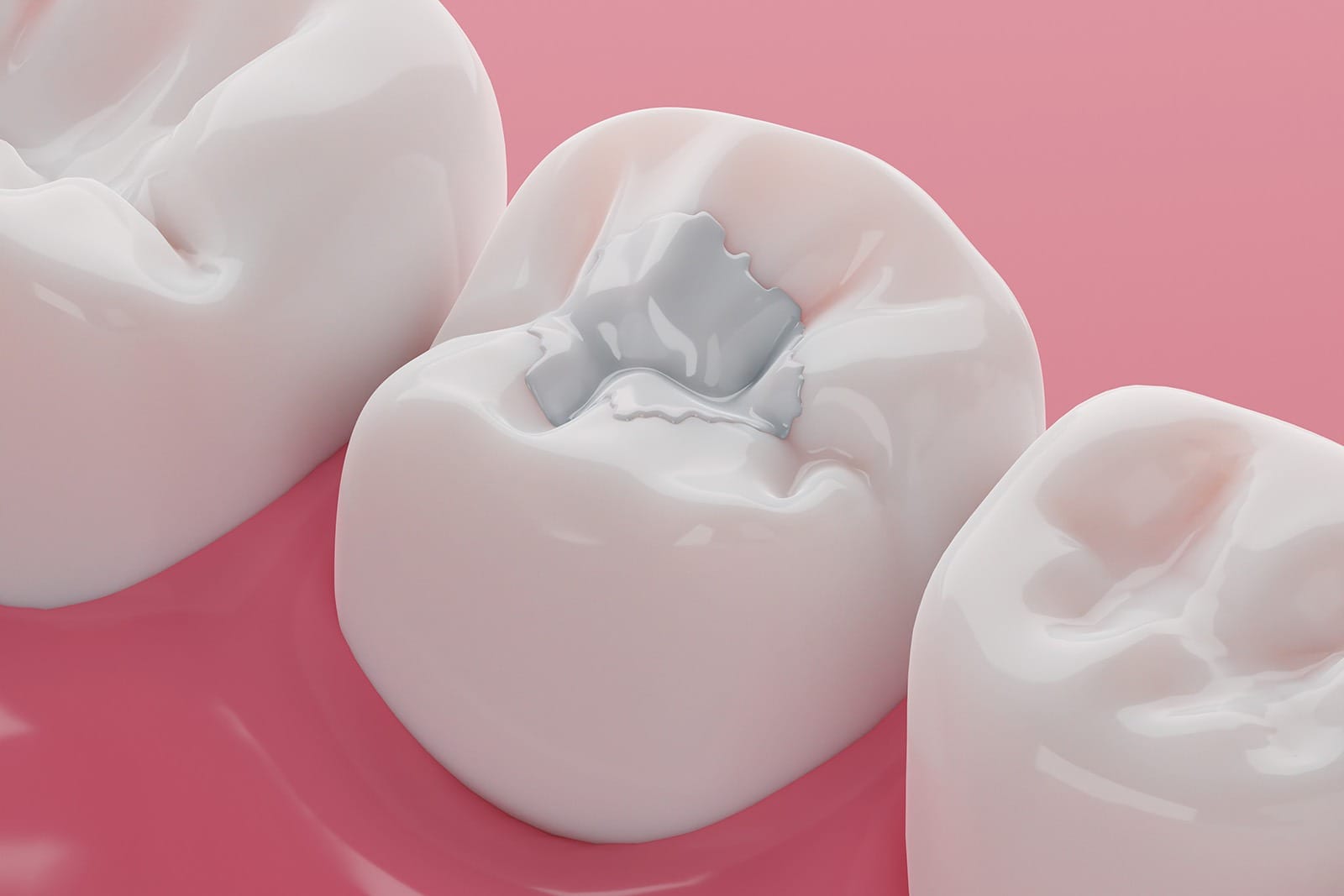 Amalgram fillings 3D model