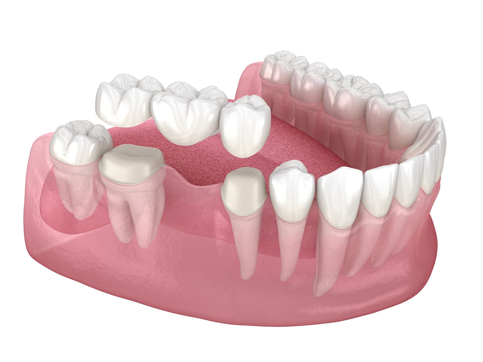 Dental bridges