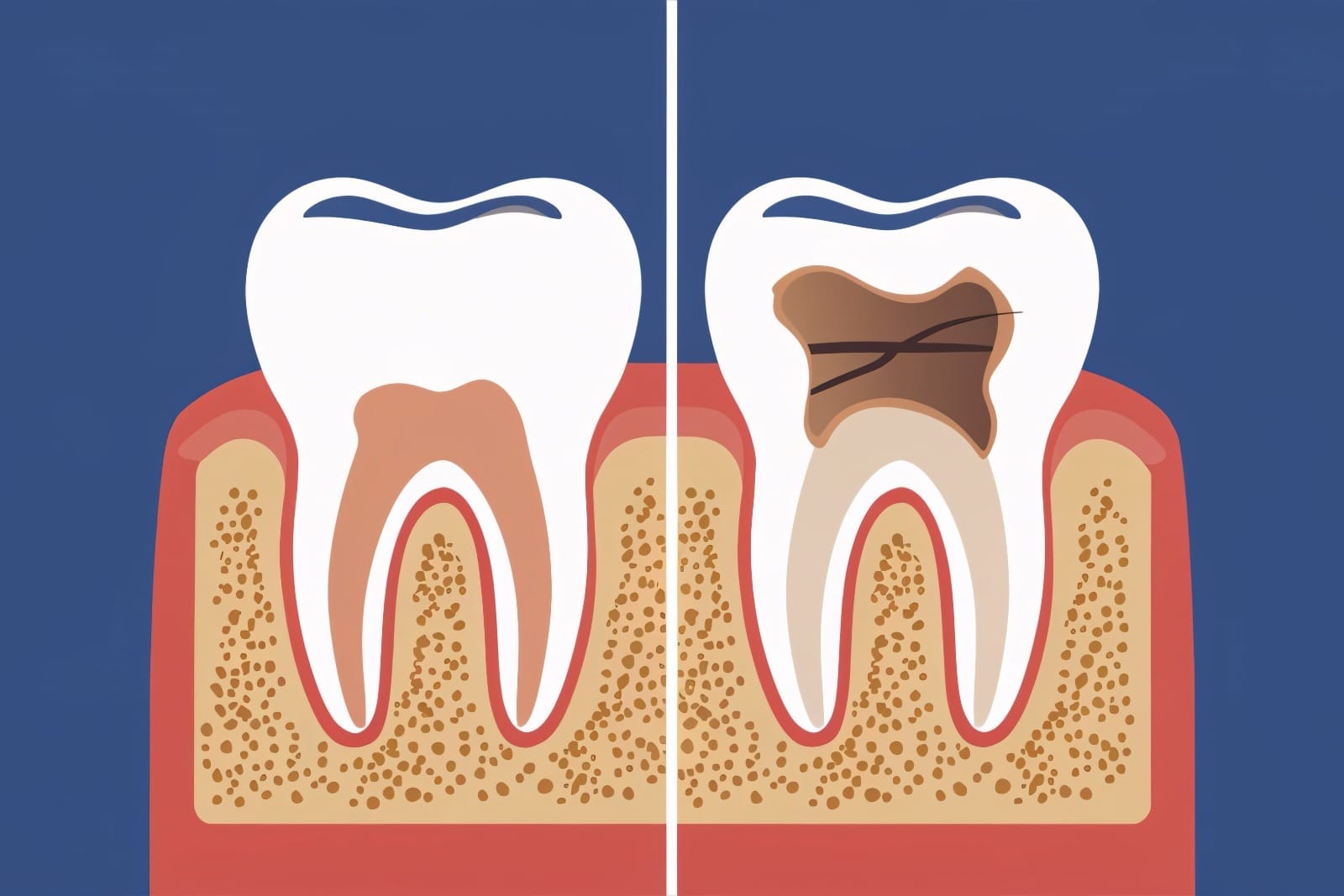 Healthy vs. Cavitated Tooth Comparison.