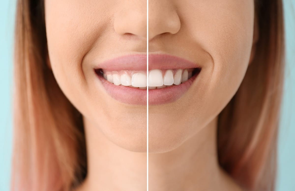 Gummy smile before and after