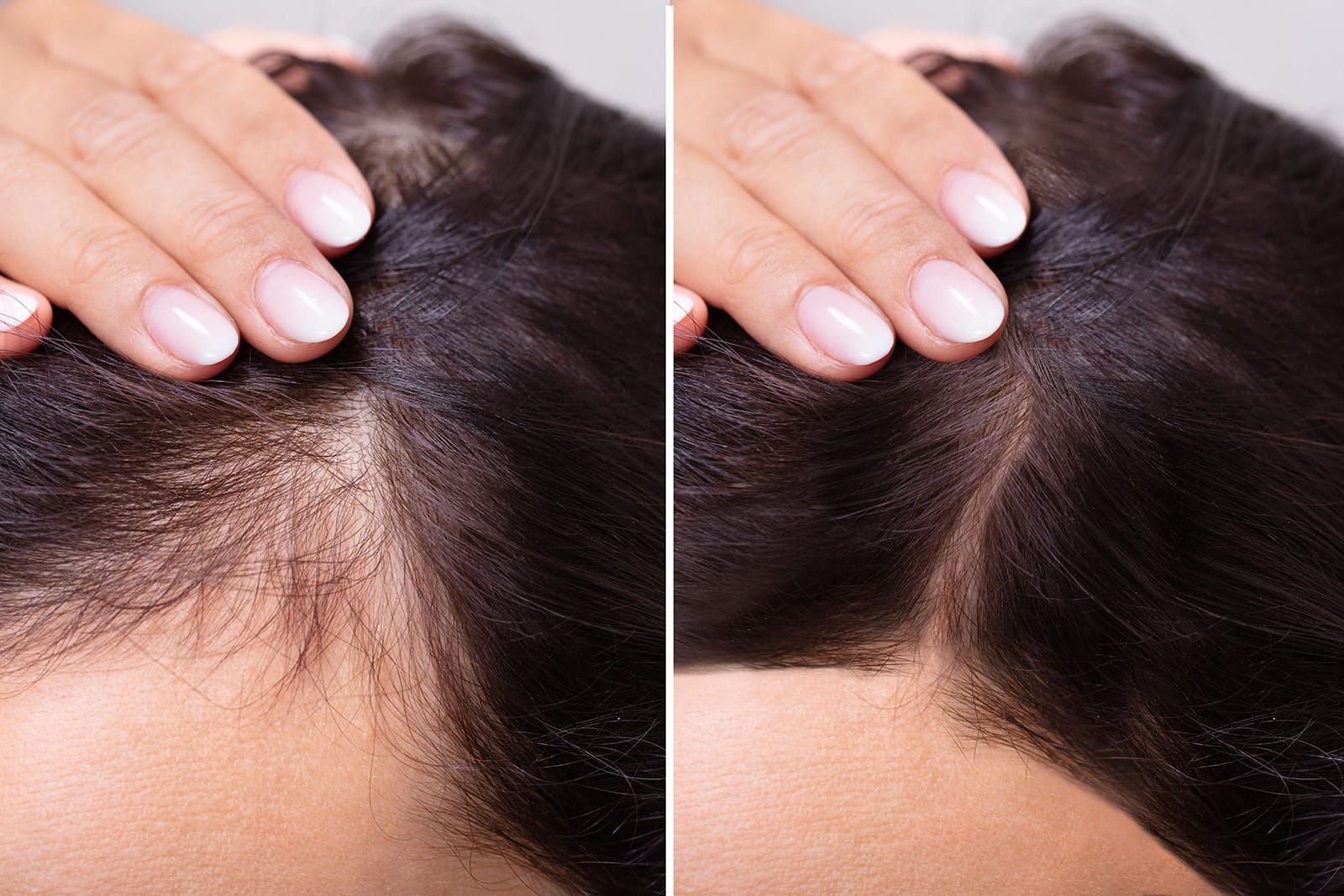 Hair loss treatment before and aftter