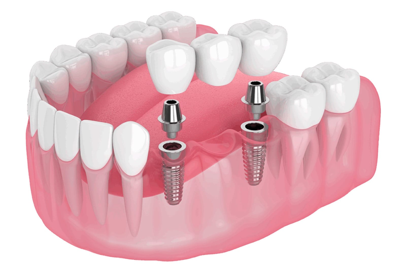 Implant bridge model