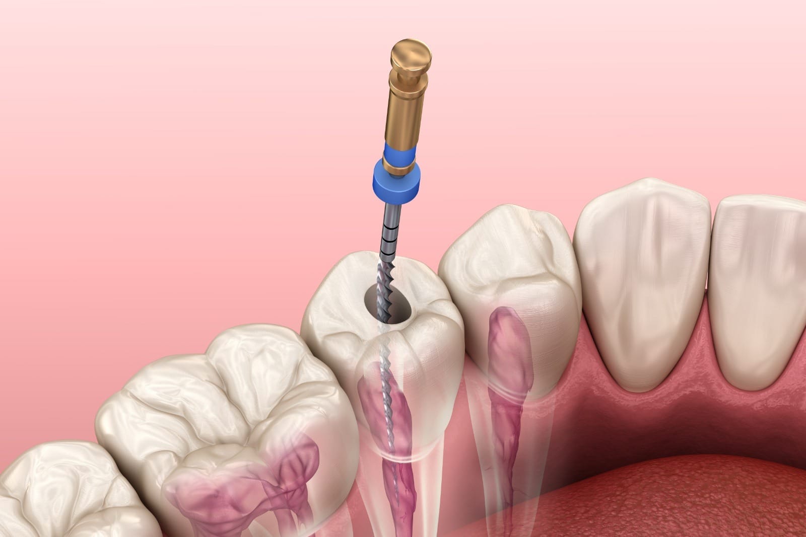 Endodontic root canal treatment process. Medically accurate tooth 3D illustration.