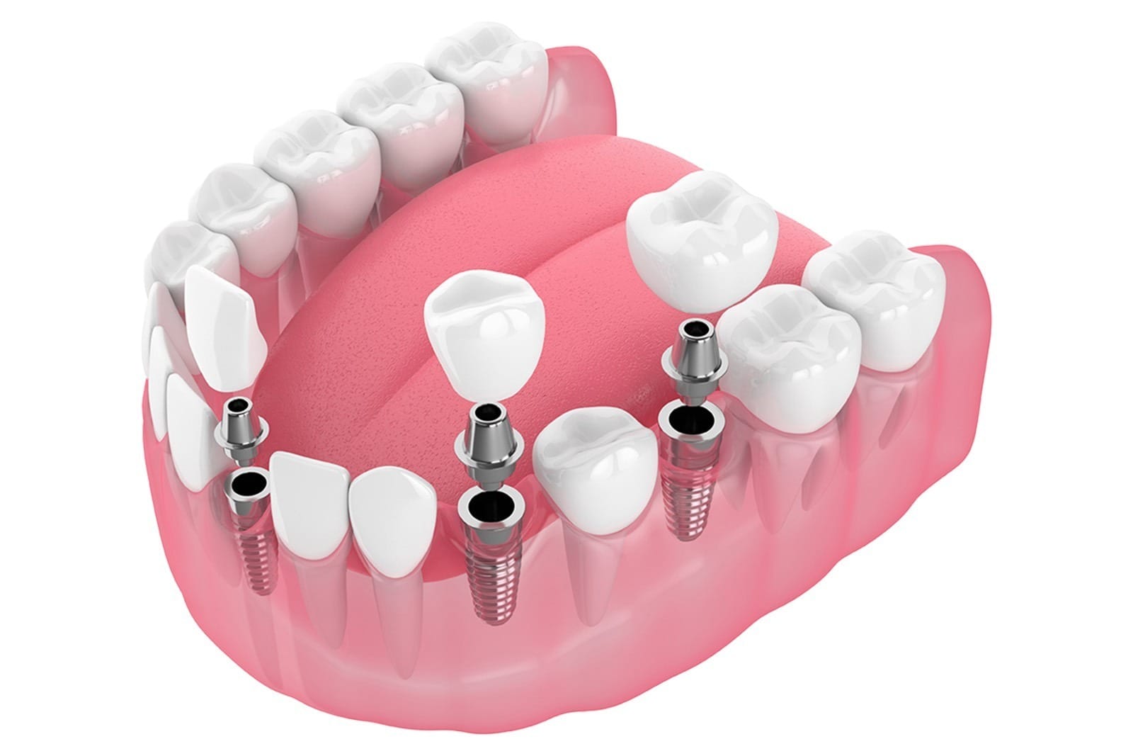 Single implant model