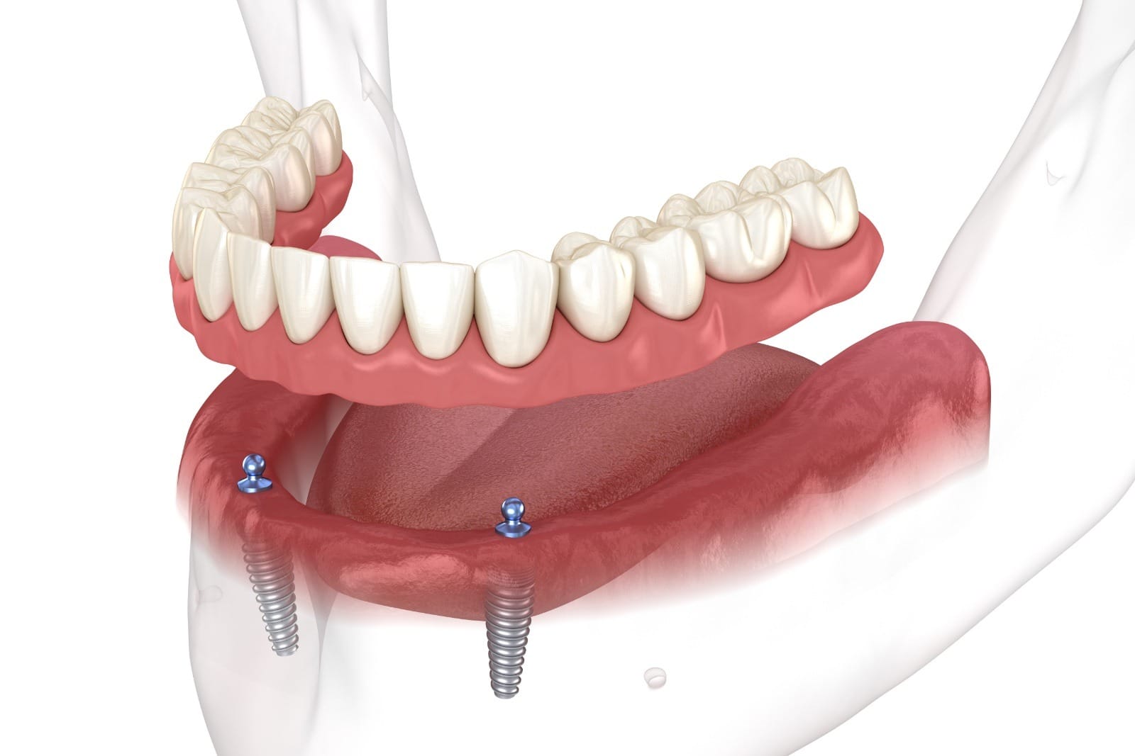 Mandibular removable prosthesis All on 2 system supported by implants with ball attachments. Medically accurate dental 3D illustration