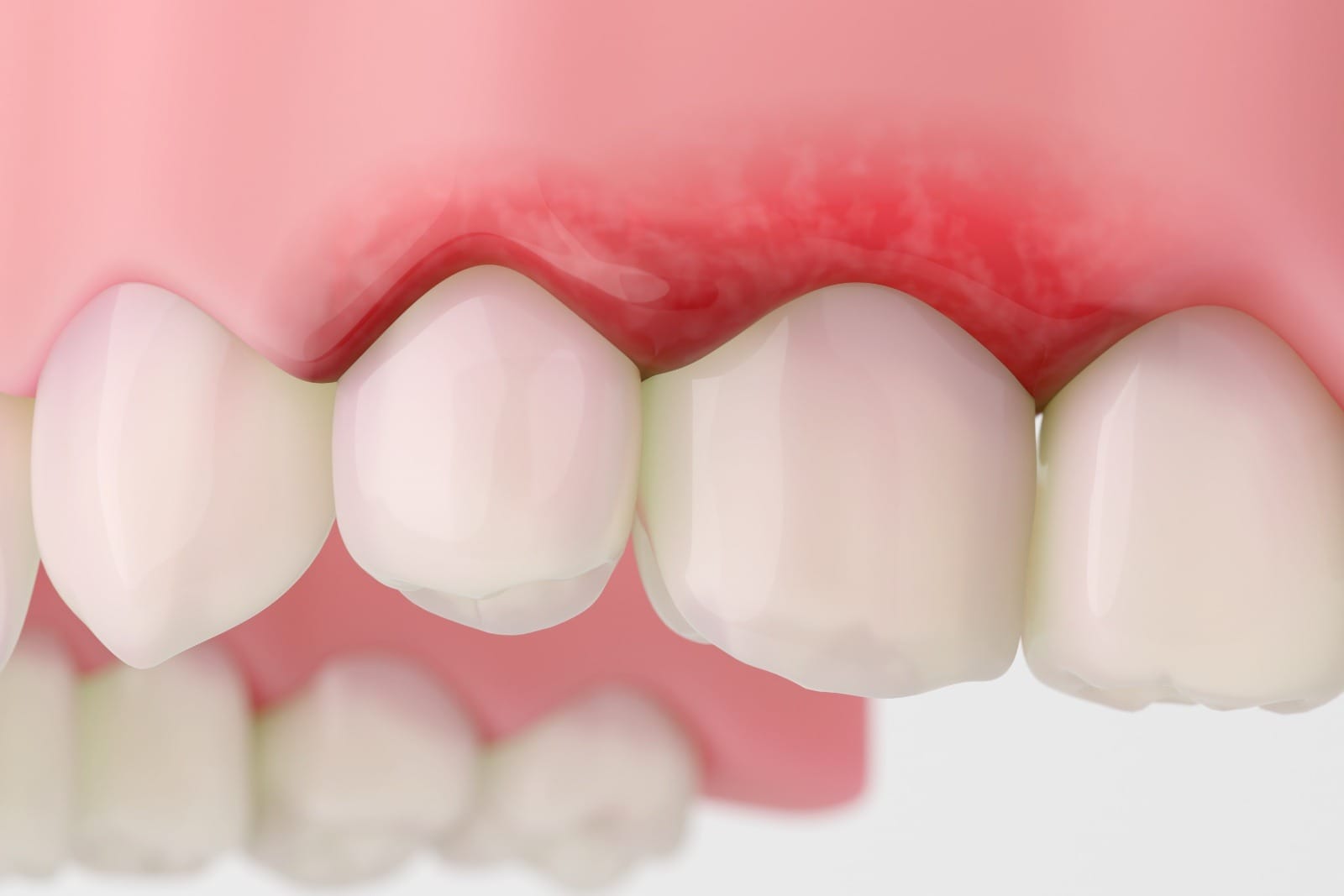 Swollen red gums with inflammation near upper molars.
