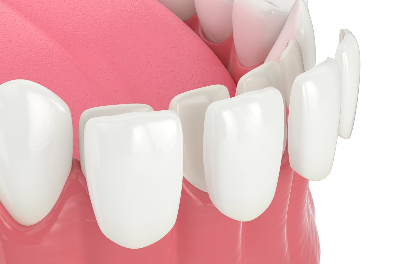 3d render of lower jaw with veneers